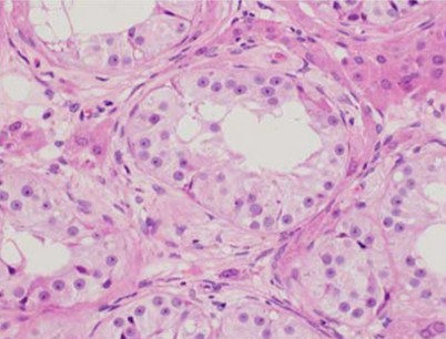 Reifungsstörungen Spermatogenese